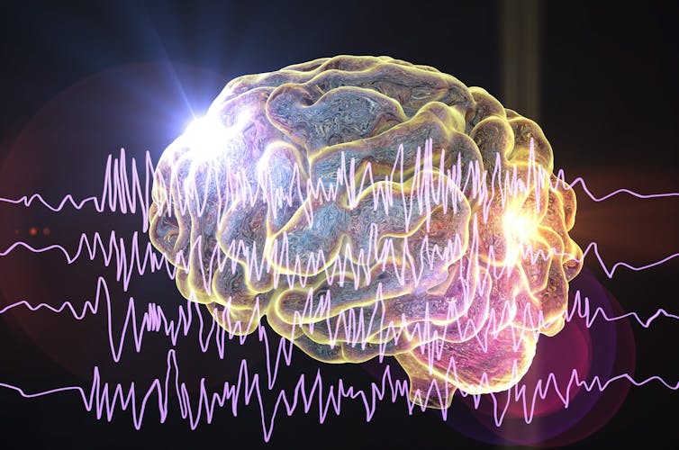 An illustration of chaotic brain waves during a seizure event.