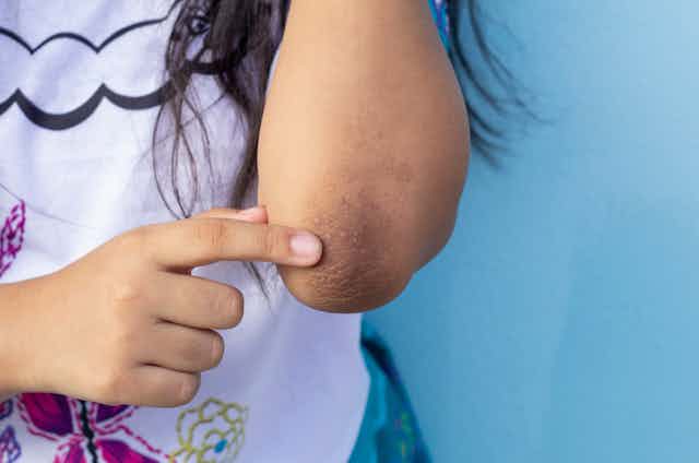 Uma menina aponta para região escurecida na pele de seu cotovelo
