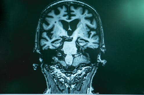 Alzheimer’s may have once spread from person to person, but the risk of that happening today is incredibly low