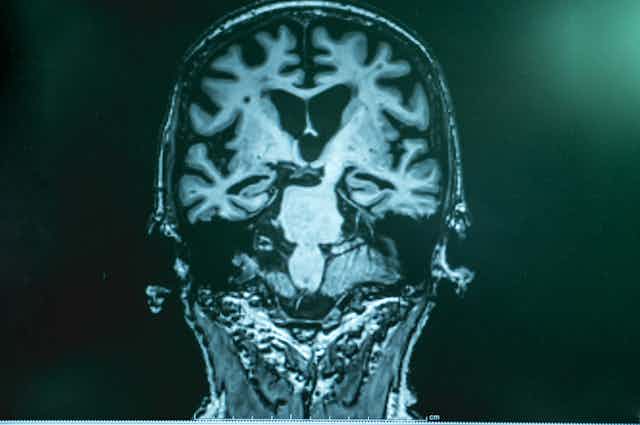 MRI of a person with Alzheimer's disease