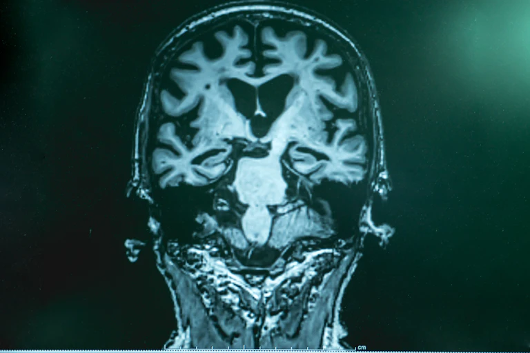 MRI of a person with Alzheimer's disease