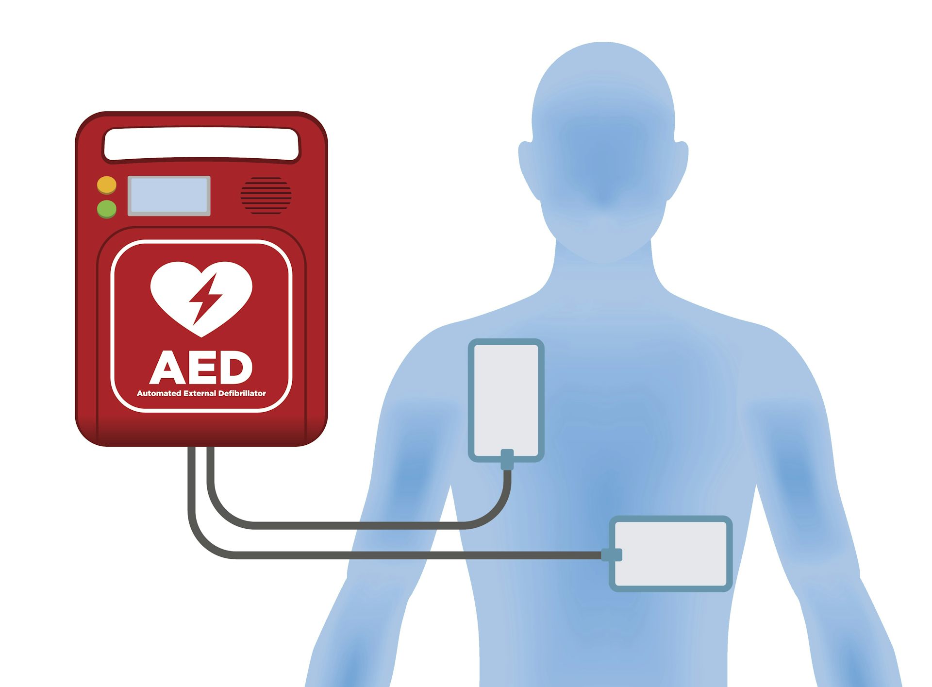 A new emergency procedure for cardiac arrests aims to save more lives