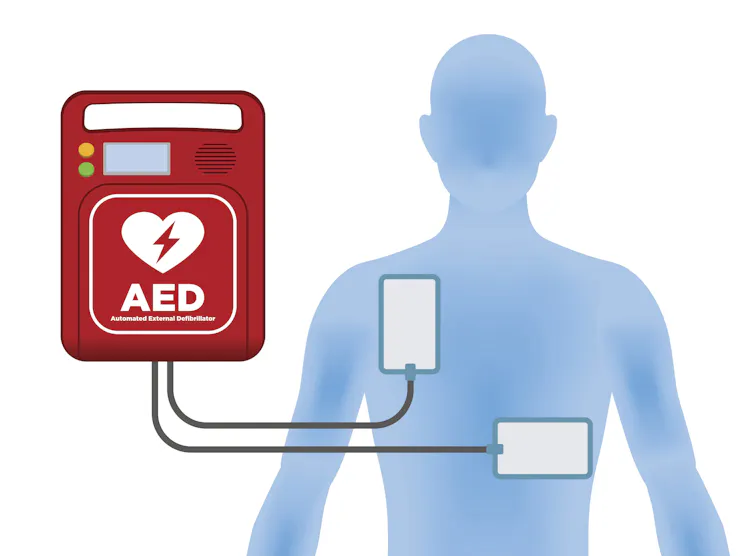Diagram showing placement of defibrillator pads on the chest area