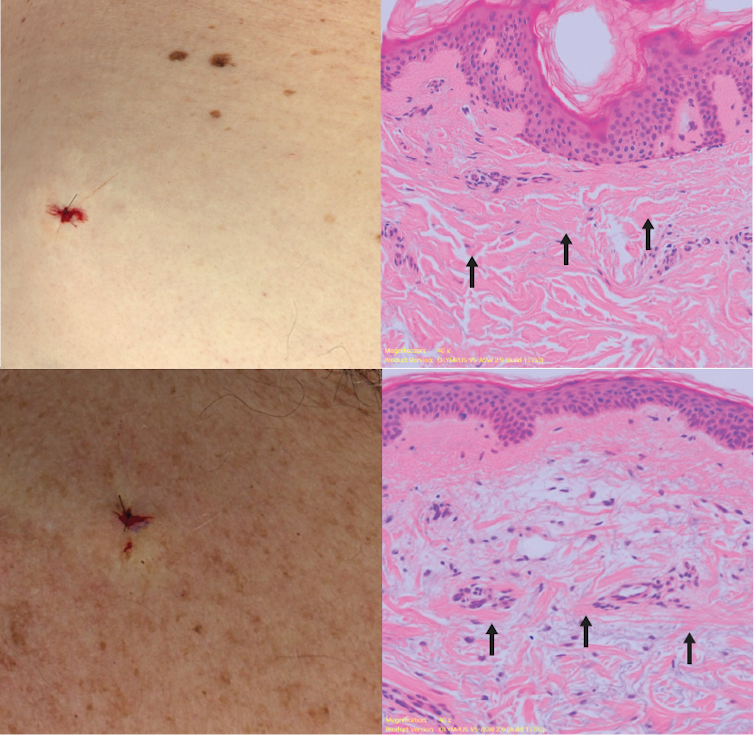 Sun-damaged skin and sun-protected skin from the same person, and the microscopic image of each showing how the collagen bundles have been thinned out in the sun-damaged skin.