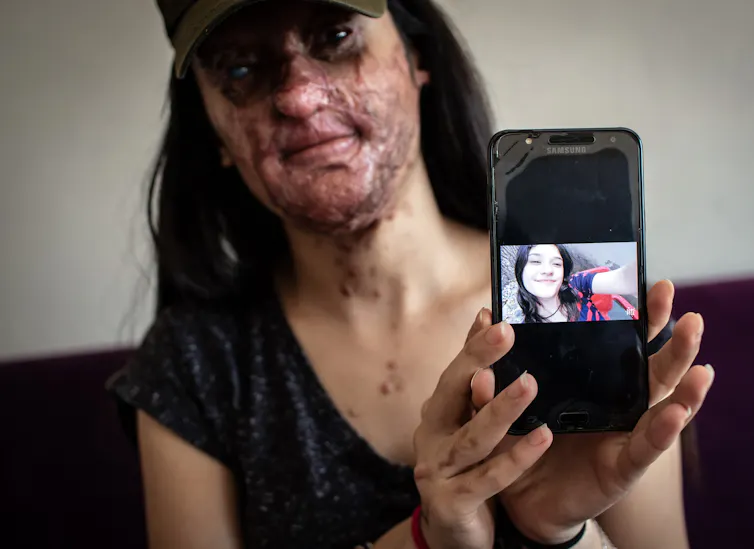 A young woman with a scarred face and long, dark hair holds up an iPhone with a photo of herself smiling without scars