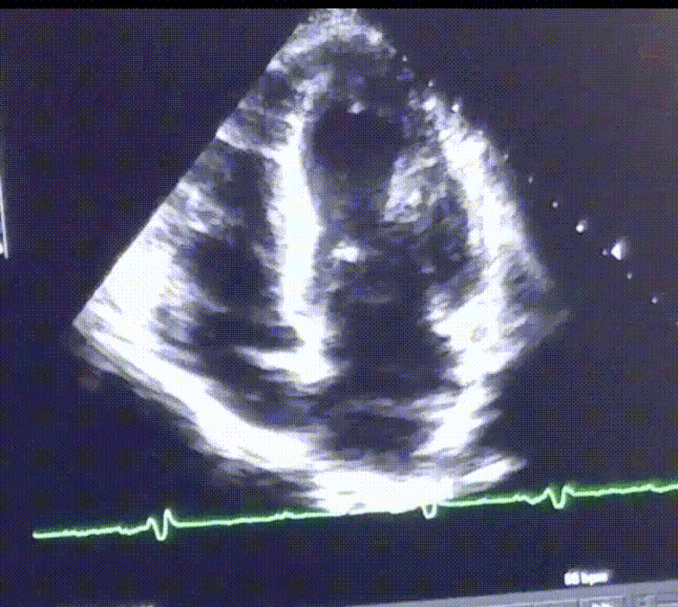 Clip of an ultrasound reading of an enlarged heart beating