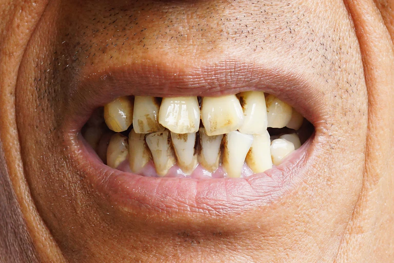 Person with bad teeth