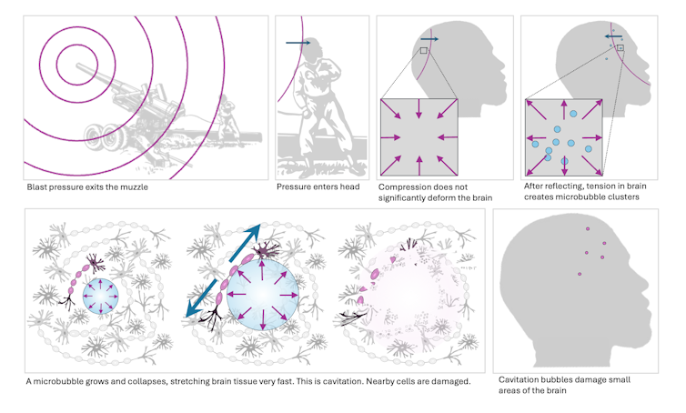 Diagram showing blast pressure creating microbubbles in the brain after reflecting off surfaces, stretching and destroying cells in a process called cavitation.