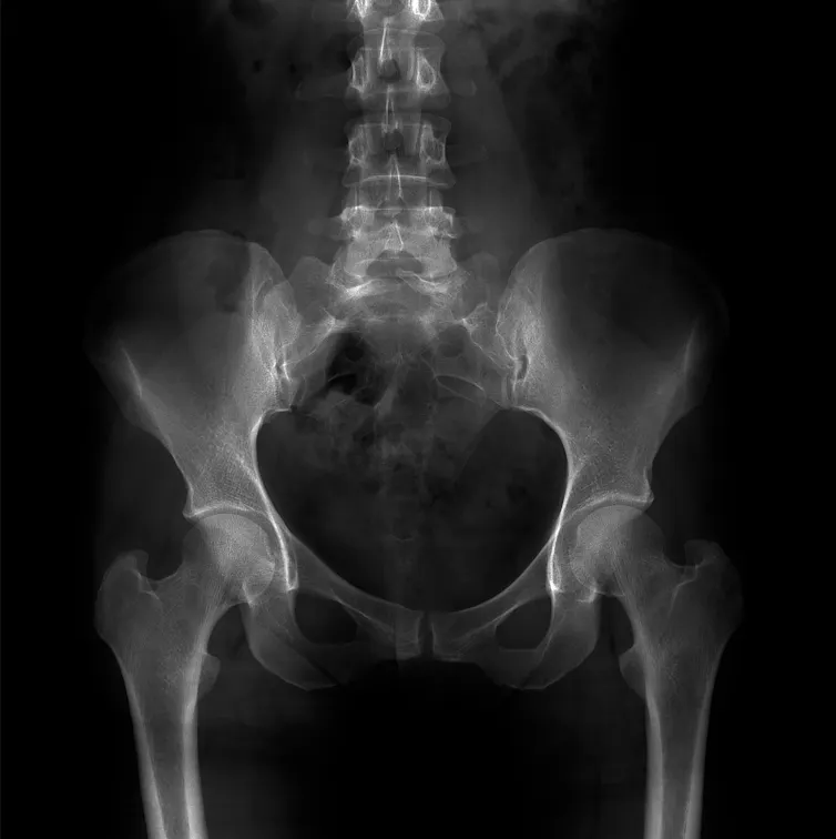 X-ray of the pelvis and the lumbosacral spine with spina bifida.