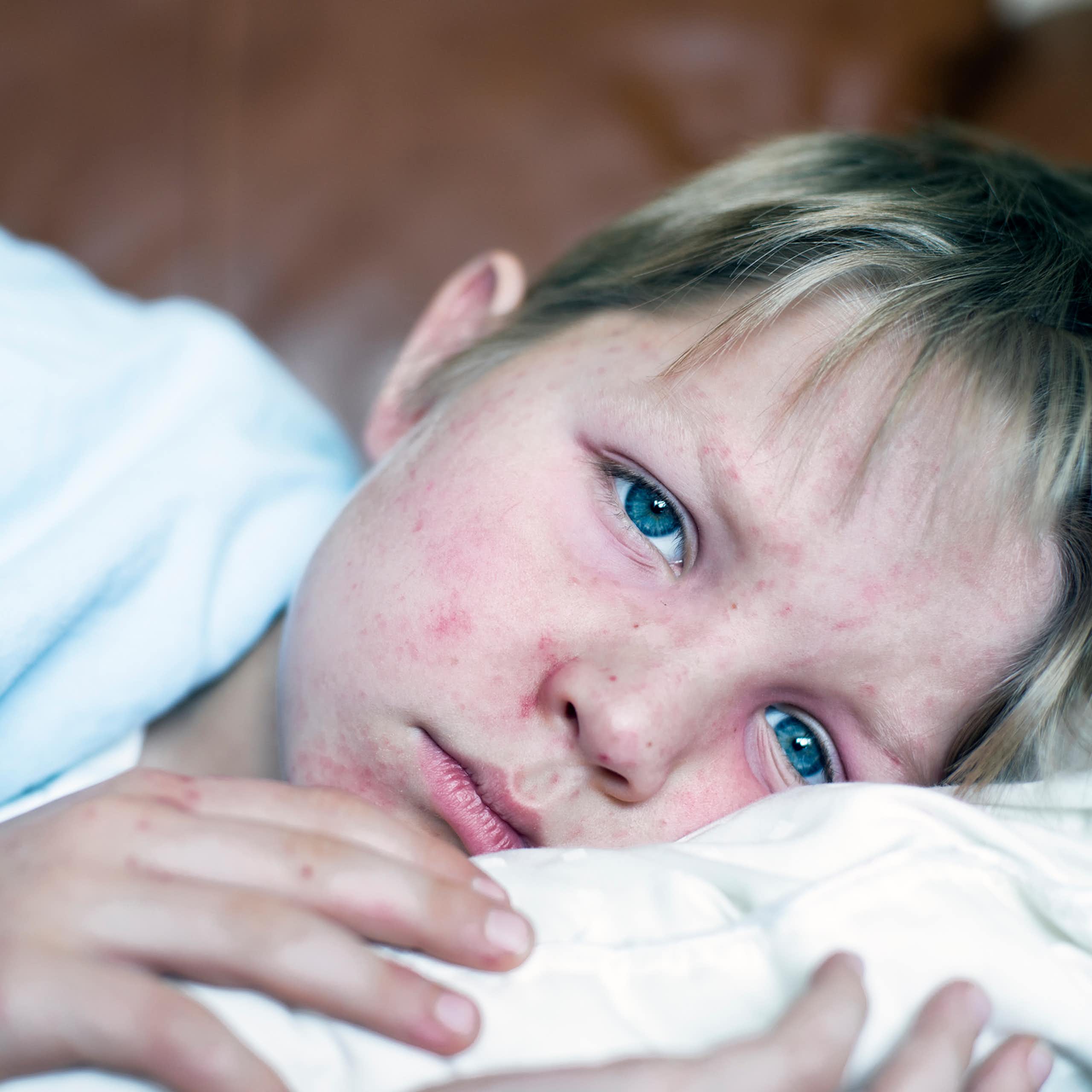 Child with red measles rash on face laying down on bed, looking at the viewer