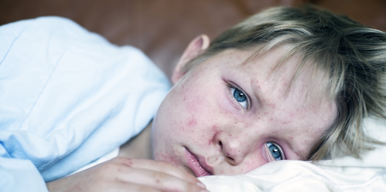 Measles is one of the deadliest and most contagious infectious diseases – and one of the most easily preventable