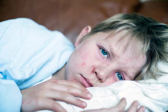 Child with red measles rash on face laying down on bed, looking at the viewer