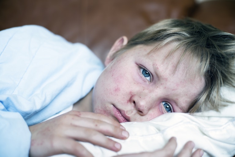 Child with red measles rash on face laying down on bed, looking at the viewer