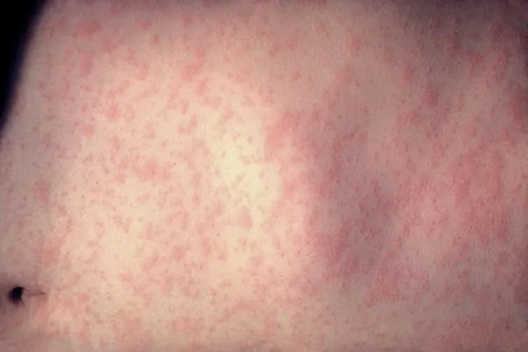 Close-up of abdomen with red measles rash