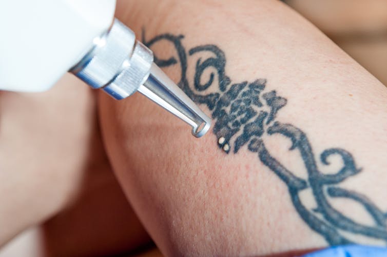 Laser treatment to remove leg tattoo