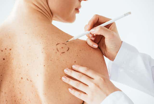 Mão de médico marca uma pinta suspeita nas costas de uma mulher