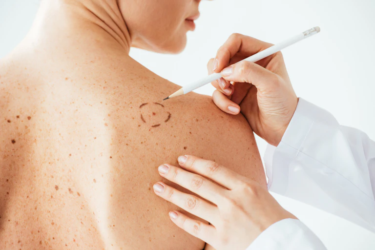 Mão de médico marca uma pinta suspeita nas costas de uma mulher