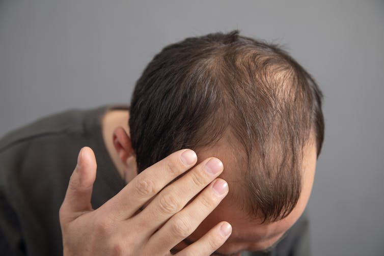 Un hombre con pérdida de cabello.