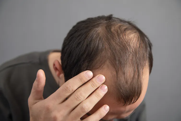 Um homem com queda de cabelo.