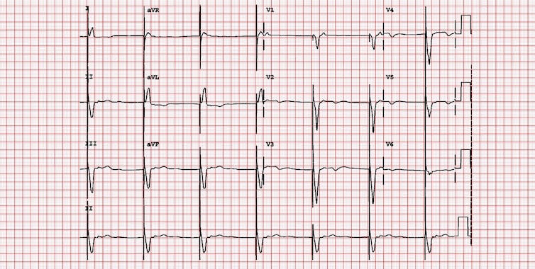 ECG reading of patient with pacemaker syndrome