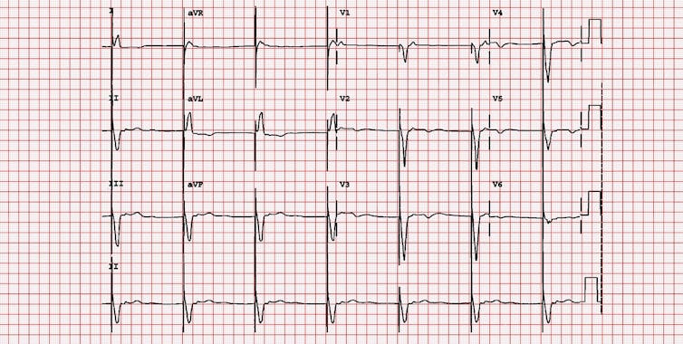 Lectura de ECG de paciente con síndrome de marcapasos