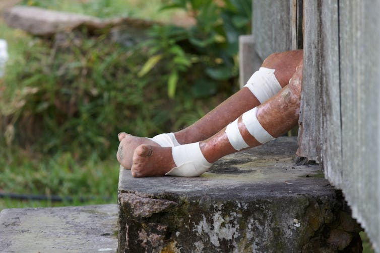 Bandaged feet and legs of a person with leprosy.