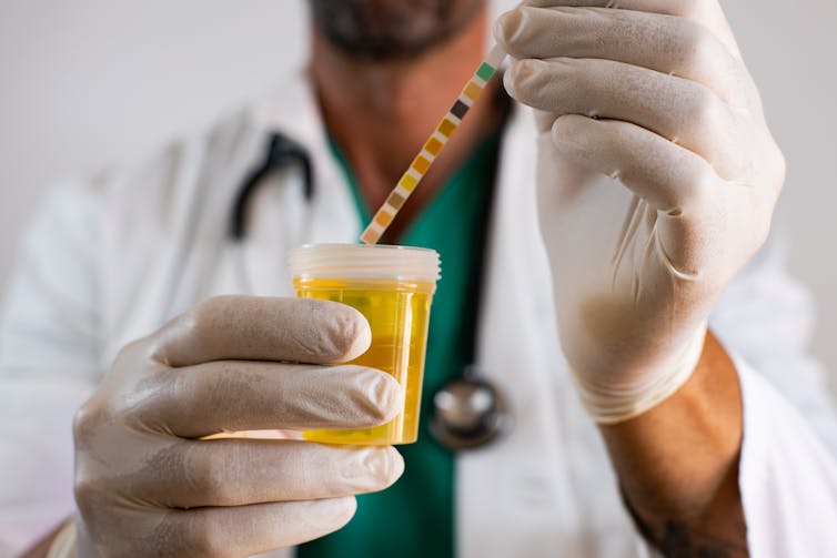 medical clinicians holds urine test and indicator