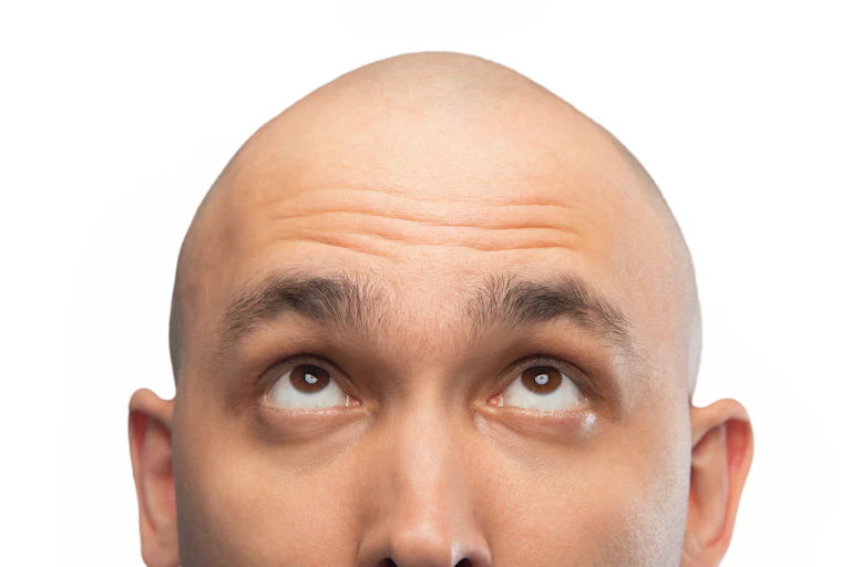 Close up photo of a bald man with light skin looking up towards his head