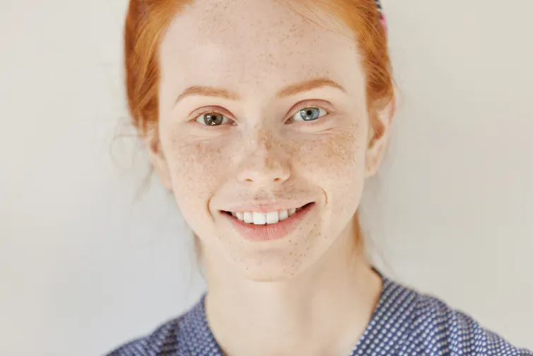 young woman smiles and has two different coloured eyes