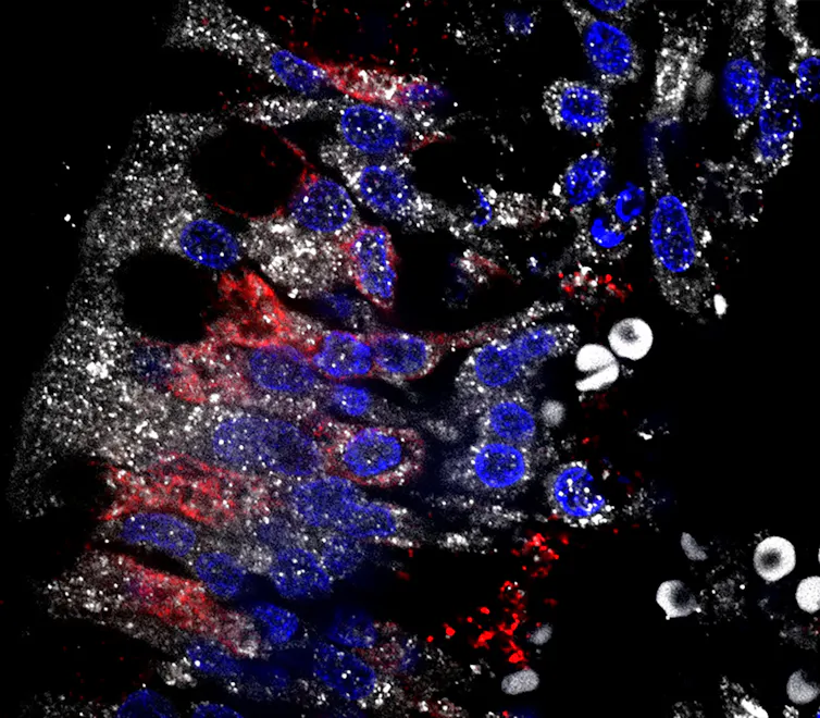 Microphotographie illustrant l’infection par le SARS-CoV-2 (la protéine S du virus est détectée en blanc) dans les neurones olfactifs exprimant la protéine marqueur olfactive (OMP, en rouge), dans la muqueuse nasale humaine.