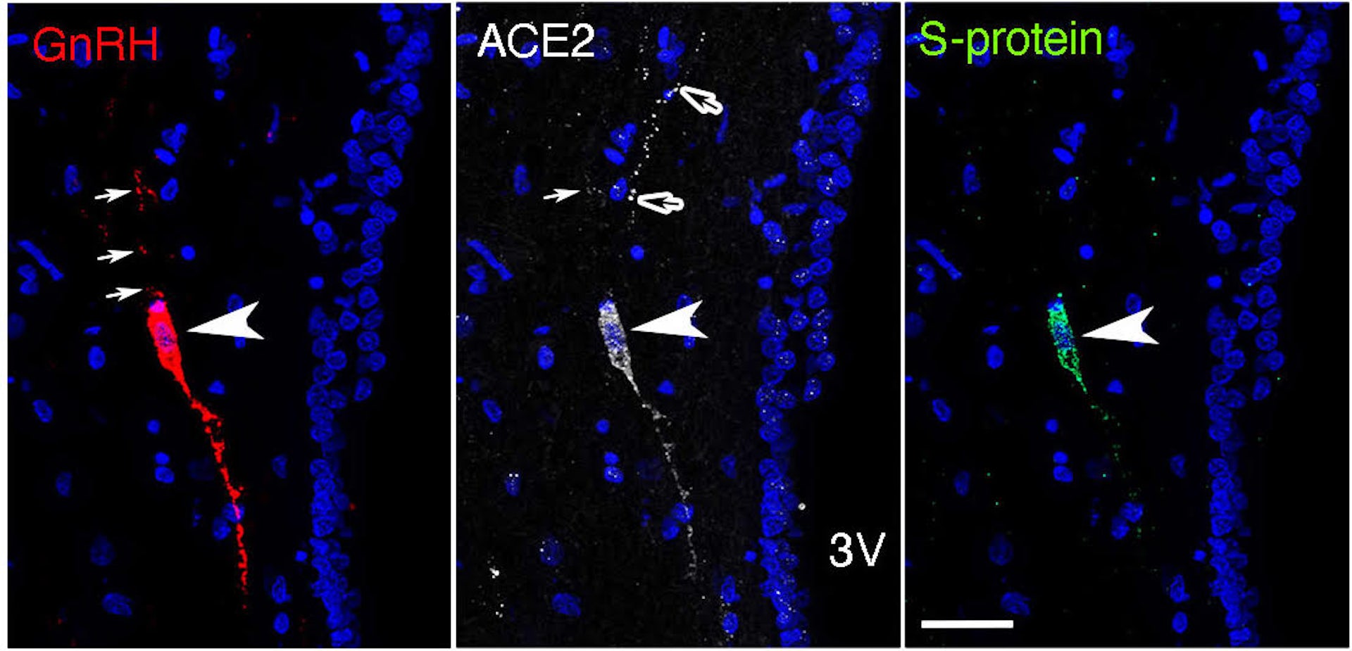 Microphotographie illustrant l’infection par le SARS-CoV-2 d'un neurone produisant la neurohormone de la reproduction GnRH