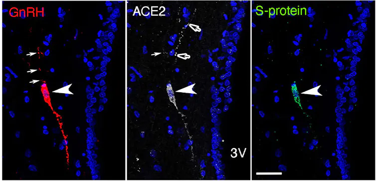 Microphotographie illustrant l’infection par le SARS-CoV-2 d'un neurone produisant la neurohormone de la reproduction GnRH