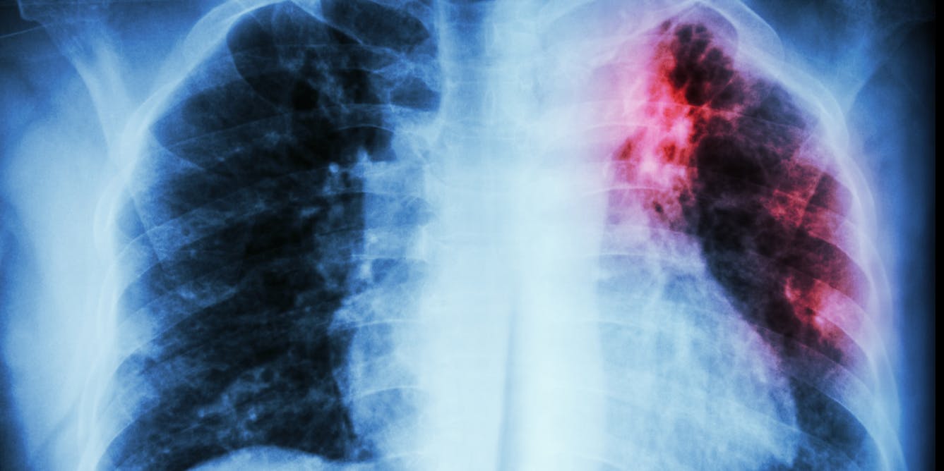 AI can assist in predicting patient response to tuberculosis treatments, leading to personalized care opportunities