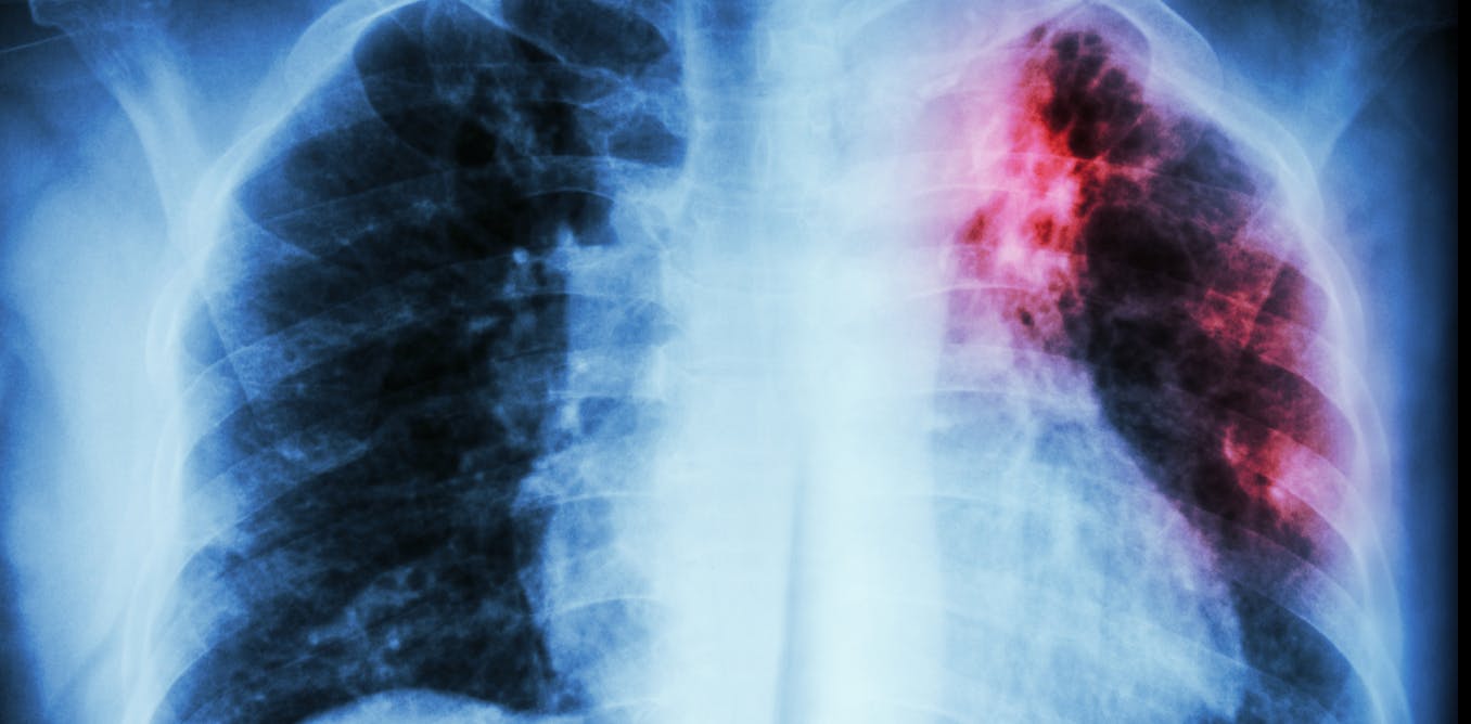 AI can assist in predicting patient response to tuberculosis treatments, leading to personalized care opportunities – GretAi News