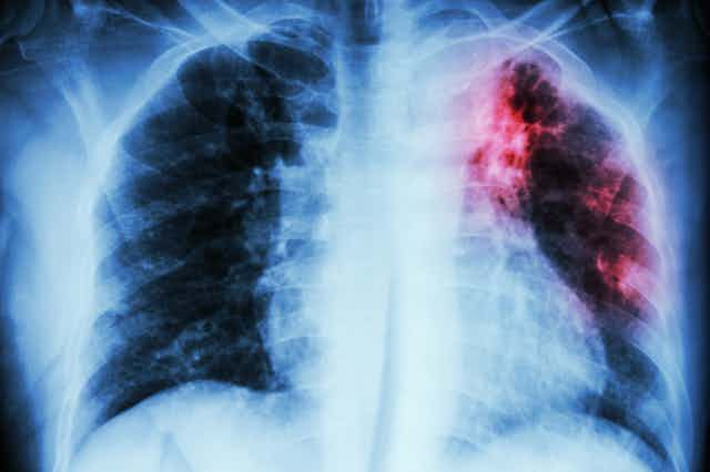 Chest X-ray with red opacity on upper left lung