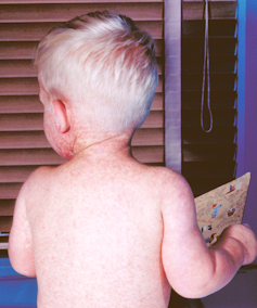 A child seen from behind with a red rash all over his skin