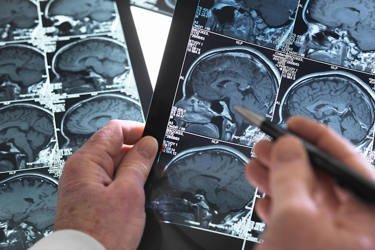 Hands holding scans of a person's brain