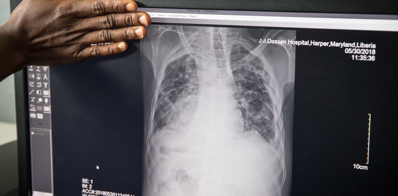Reducing poverty is the key to eliminating tuberculosis, despite advances in medical science. Reducing poverty is the key to eliminating tuberculosis, despite advances in medical science.