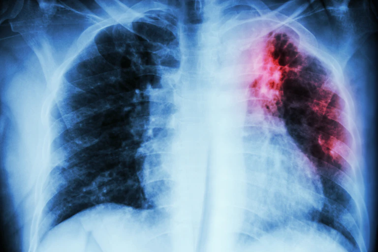 Radiografia de tórax com opacidade vermelha na parte superior do pulmão esquerdo