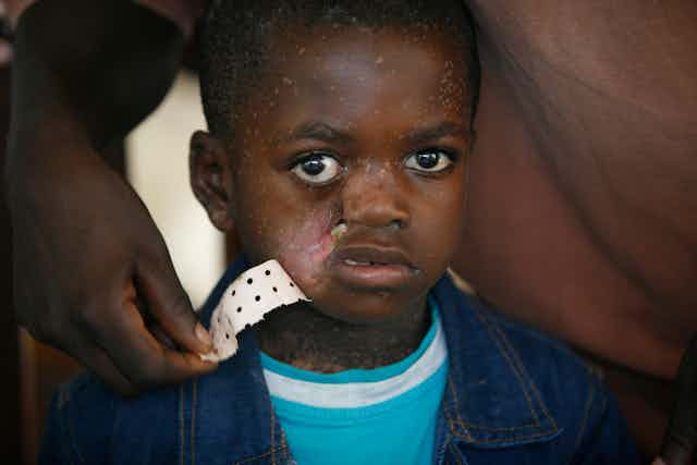 Child affeted by Noma disease