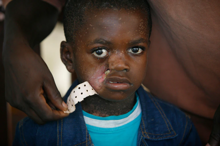 Child affeted by Noma disease