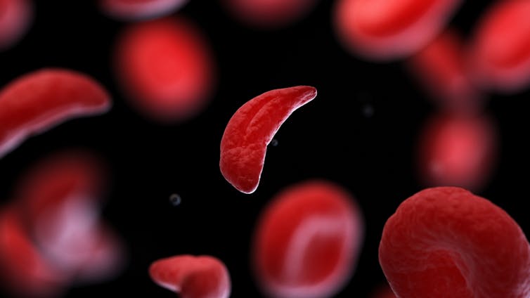 Sickle cells have a different shape to healthy round red blood cells