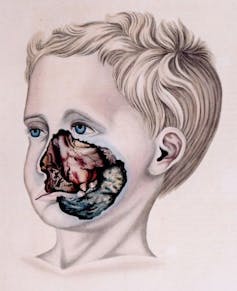 A medical artist's drawing of a boy with noma.