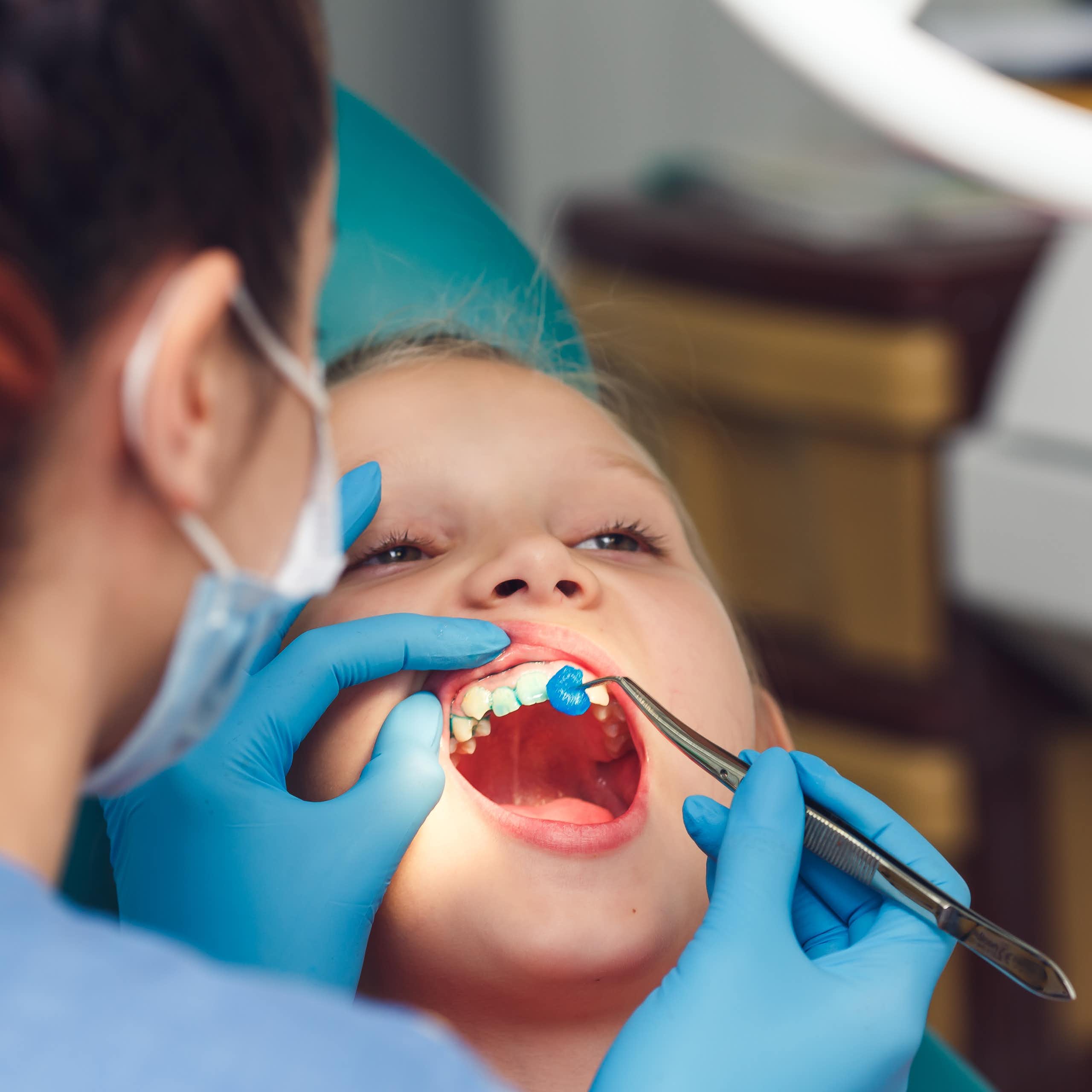 Las manchas en los dientes de los niños pueden revelar futuras caries y fracturas