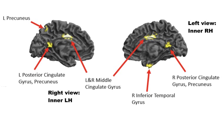 Slide showing views of brain with different areas lit