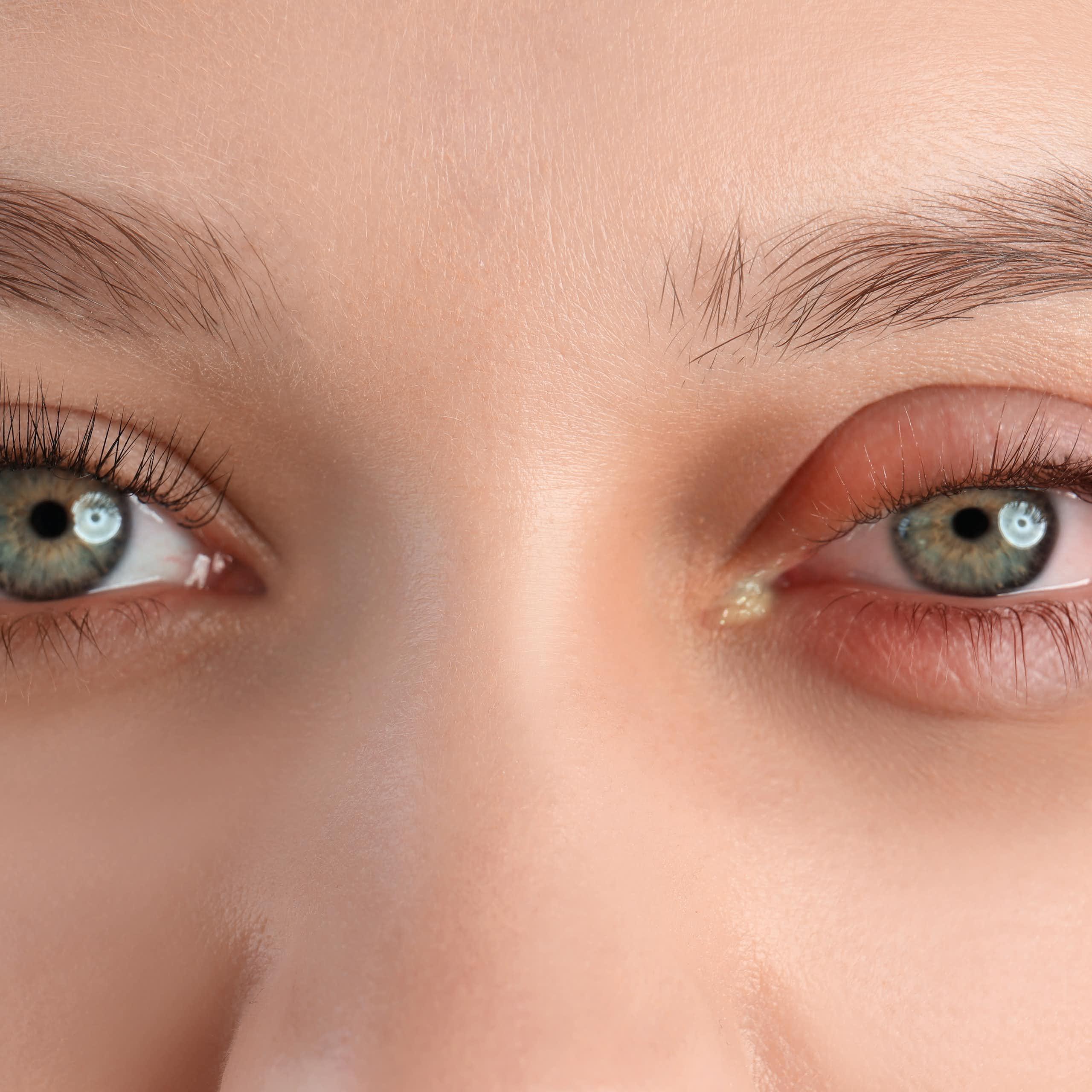 Eye infections might seem like a minor complaint – but in some cases they can cause blindness and even death