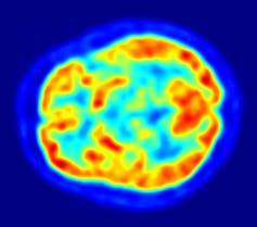 Par tomographie à émission de positrons, le cerveau apparaît en différente teinte allant du bleu au rouge, en fonction de la concentration d’un marqueur injecté chez le patient