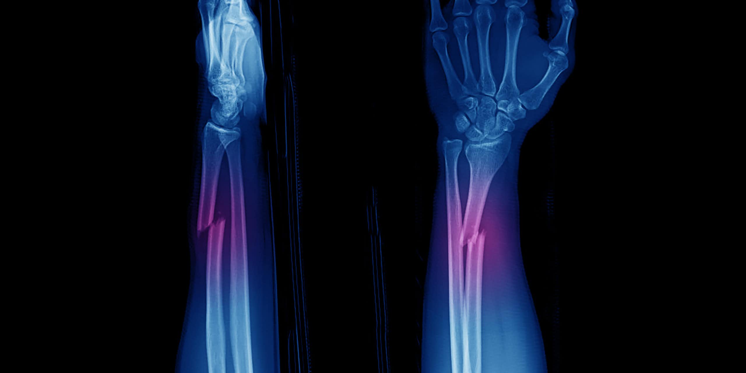 Enfermedad de los huesos de cristal: una rara alteración genética que quebranta la salud ósea