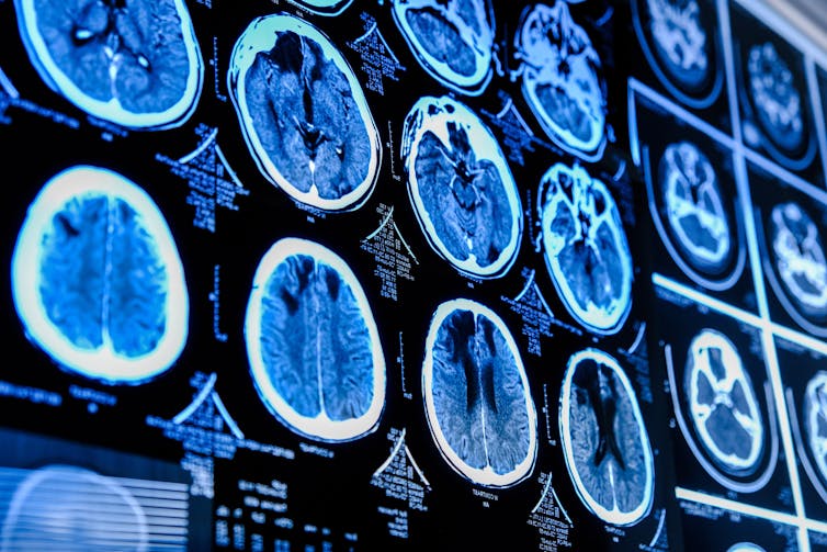 CT scans of the brain.