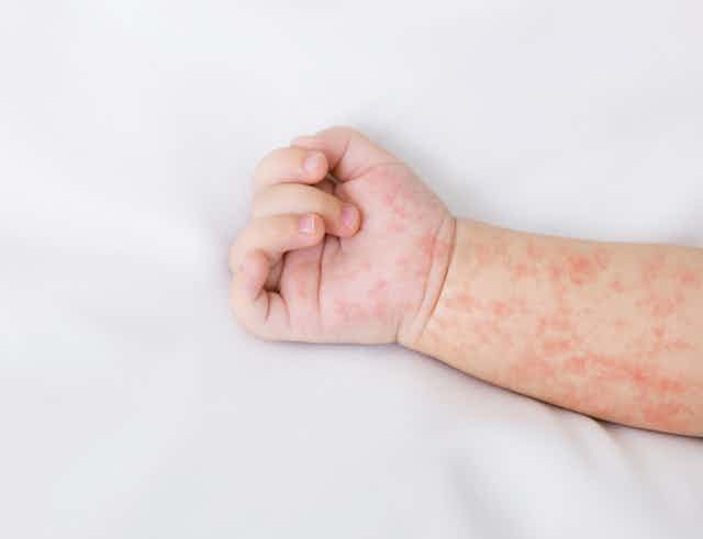 A baby's arm and hand with a red rash